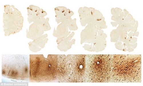 Phát hiện loại protein hỗ trợ chẩn đoán bệnh gây hại não mãn tính