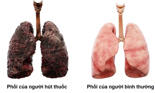 Sự khác nhau của phổi người hút thuốc lá và không hút thuốc